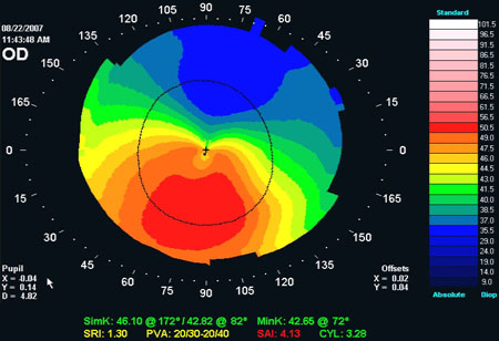 Keratoconus Treatment Reading, PA