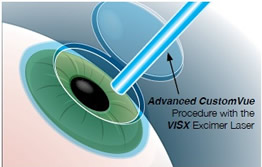 VISX Star S4™ excimer laser Reading, PA