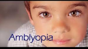 Amblyopia (Lazy Eye) blog