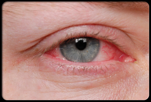 Eye Allergies blog of Berks Eye