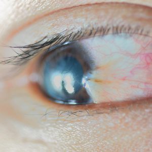 What causes pterygium Reading PA