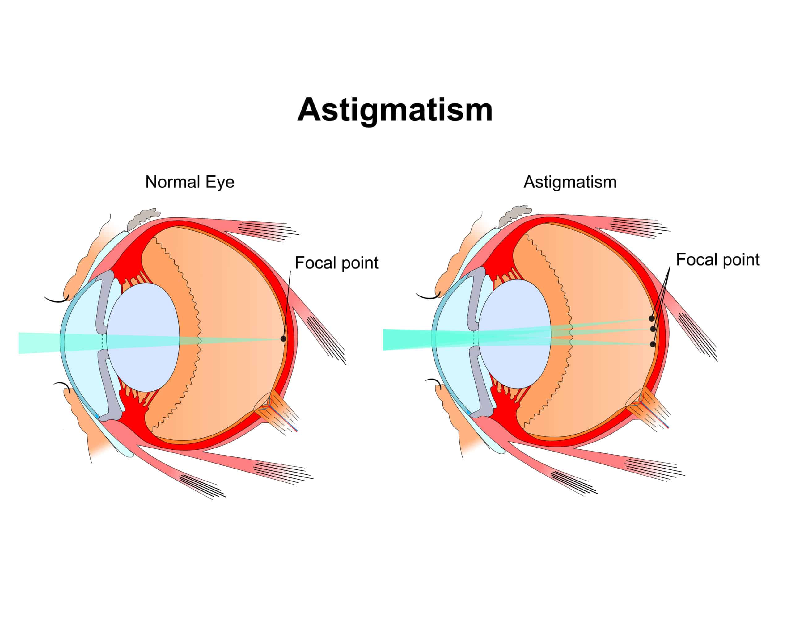 Astigmatism Treatment