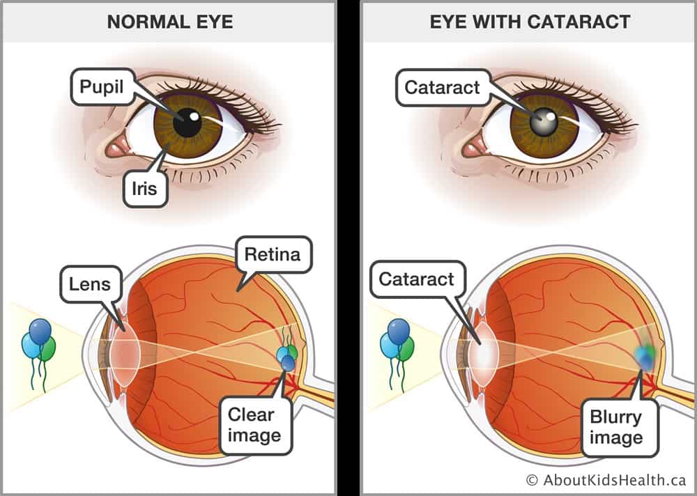 Cataract Specialist Reading PA