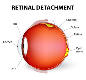 Retinal Detachment Diagram