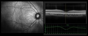 Eye Exam (OCT) for Detecting a Retinal Tear/ Detachment