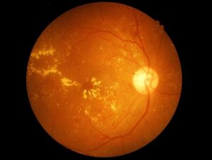 Retinal Vein Occlusion Image