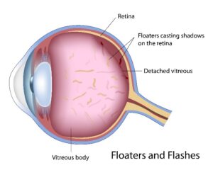 Eye Floaters & Flashes Treatment in Reading, PA