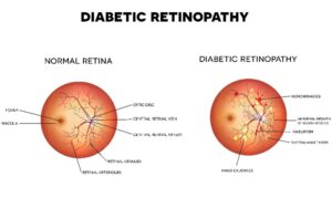 Diabetic Retinopathy Treatment in Reading, PA