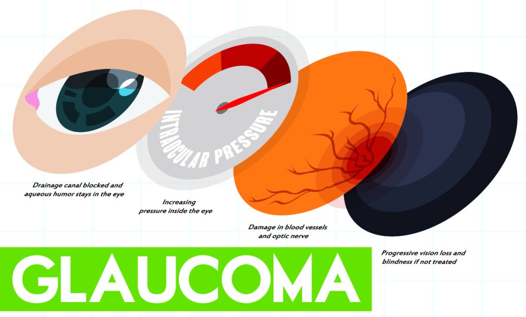 Glaucoma in Wyomissing