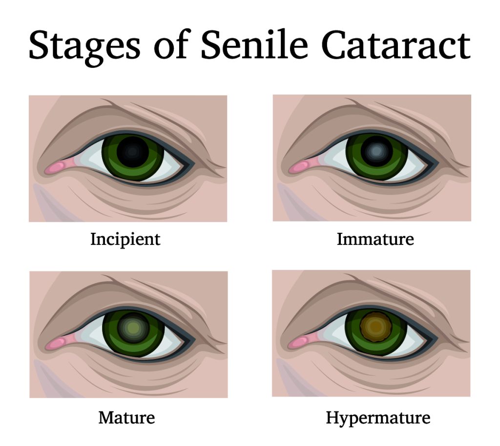 Cataract surgery in Wyomissing